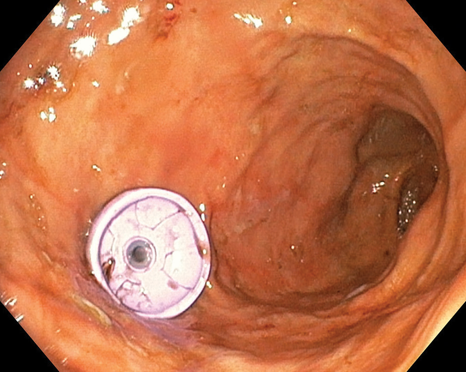 The internal bumper abutting on the gastric wall.